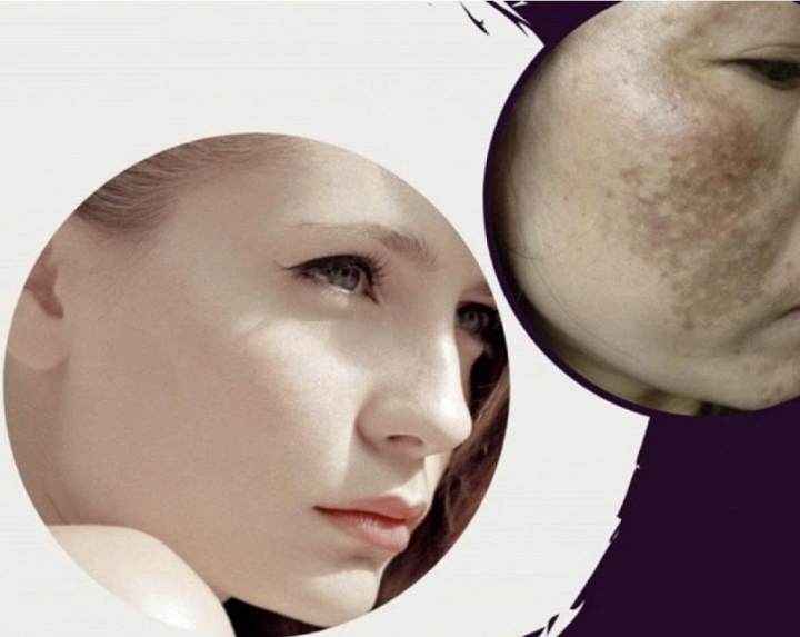 KEM DƯỠNG LÀM MỜ NÁM MASSAGE CREAM NO 2 – GIẢI PHÁP CHUYÊN SÂU CHO LÀN DA SÁNG MỊN, ĐỀU MÀU